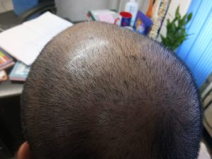 cupping therapy for hair loss