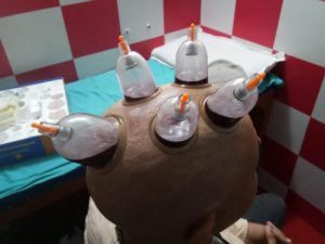 cupping therapy for hair loss