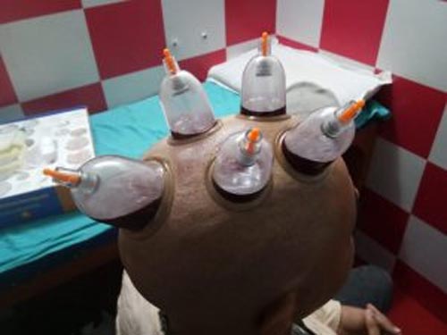 Cupping (Hijama) Treatment For Hair Loss