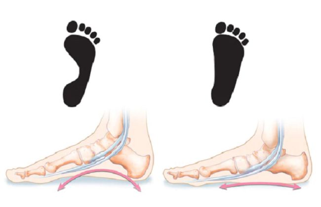 Flat-Foot-Treatment