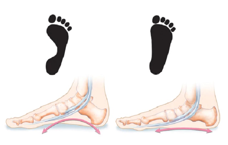 Flat-Foot-Treatment