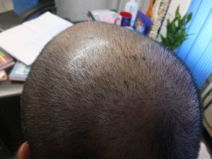 hijama therapy for hair loss in Delhi