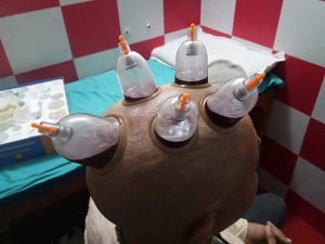 hijama therapy for hair loss in Dwarka