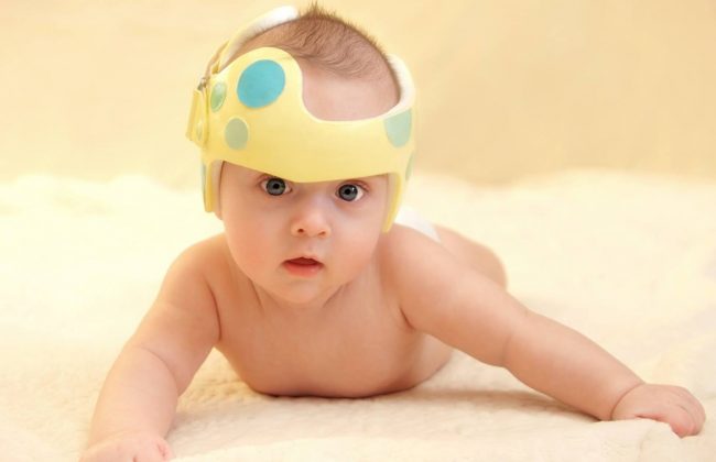 plagiocephaly