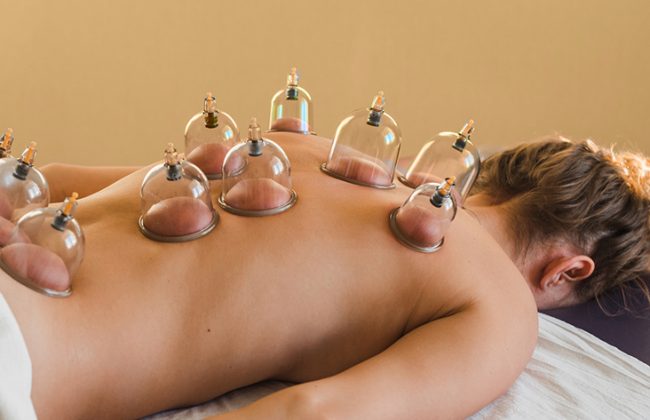 cupping therapy in Dwarka